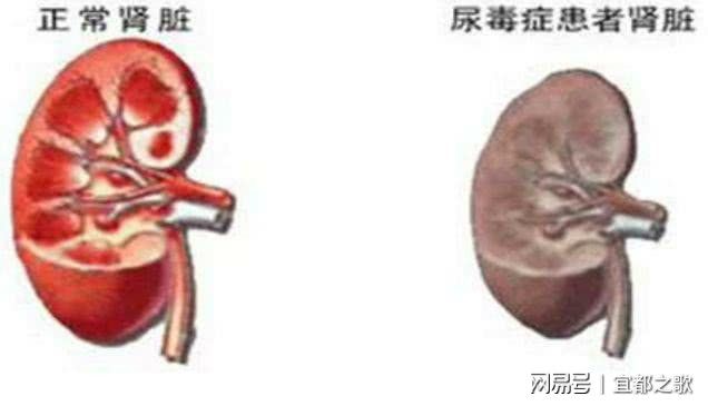 尿毒症克隆肾最新技术，重塑肾脏健康的希望之光